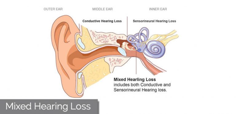 mixed-hearing-loss-know-cause-symptoms-best-treatment