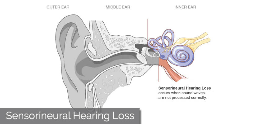 Sensorineural Hearing Loss Get Best Treatments Diagnosis