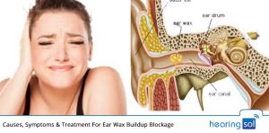 EarWax Removal | 13 Best Home Remedies To Get Wax Out