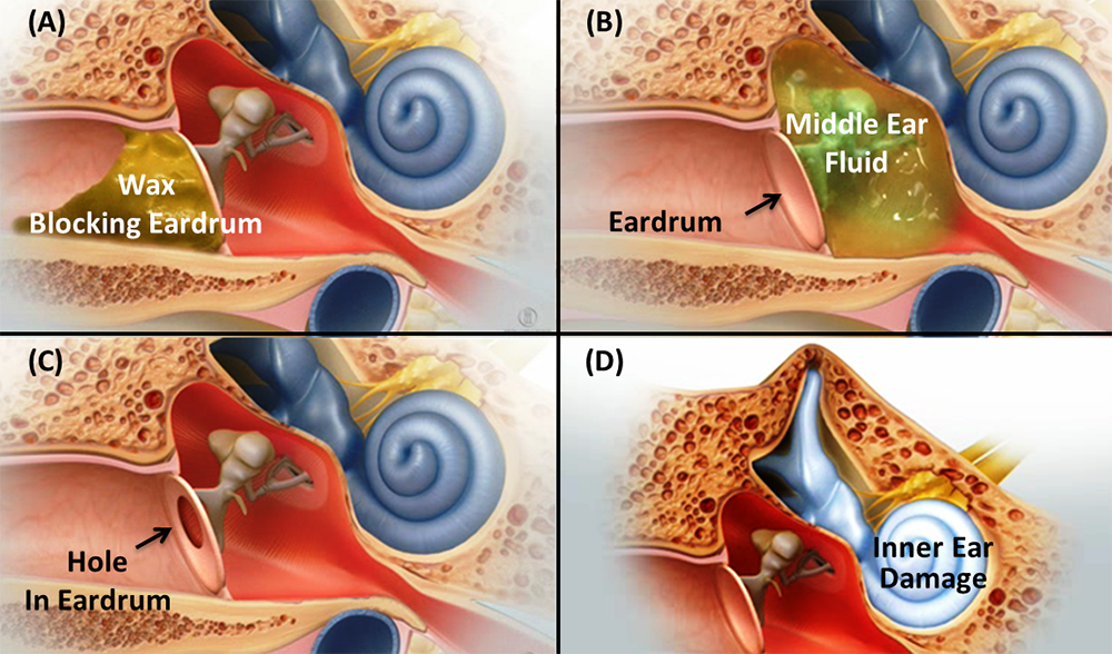  Conductive Hearing Loss Causes Symptoms Best Treatment