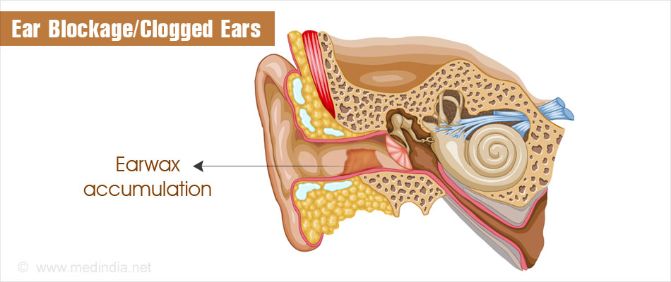Clogged Ears Stopped Up Ear 7 Instant Ways To Unclogfix