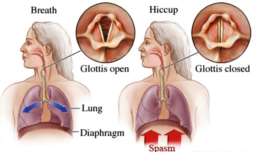 Hiccups Causes Signs Risk Factors Diagnosis Treatment