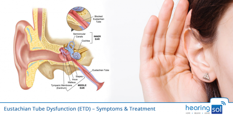 Eustachian Tube Dysfunction Etd Symptoms And Treatment 8255